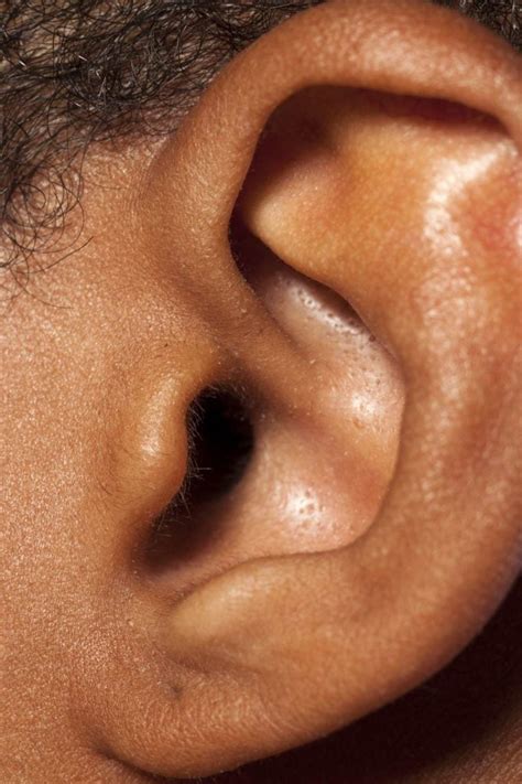 Bug In Ear Symptoms And How To Get It Out