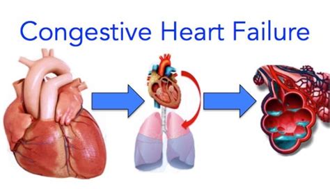 Congestive Heart Failure 99science