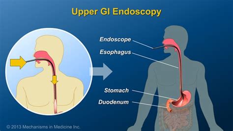 Upper Gi Endoscopy Procedure