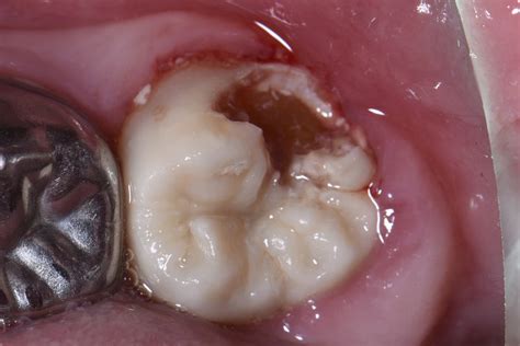 Direct Restoration On Partially Erupted Hypomineralized Second Molar