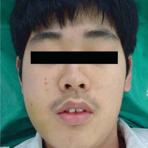 Extraoral Photograph Shows A Swelling On The Right Cheek Causing Facial