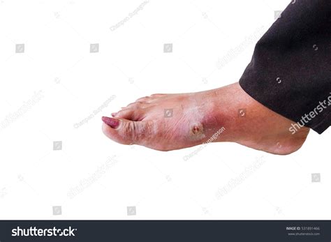Infected Wound Right Foot Abscess Swelling Foto Stok 531891466