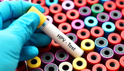 Test De Virus Del Papiloma Humano Vph Ginecolog A Oncol Gica En Per