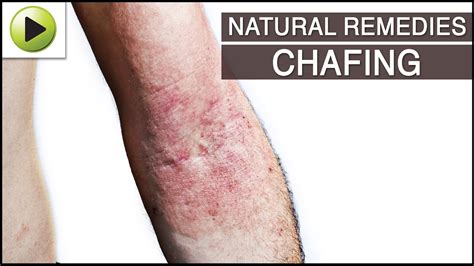 Skin Care Chafing Natural Ayurvedic Home Remedies Youtube