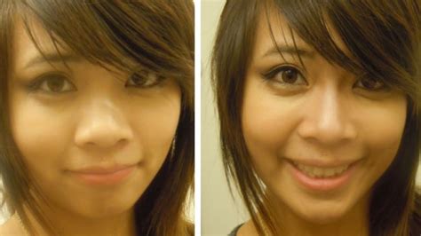 A wide nose is corrected with osteotomy on the sides of the nose bridge. Flat/Wide nose?? Improve it with Makeup! | Nose contouring, Nose makeup, Wide nose