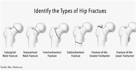 Pin By Luisvaldivieso On Osteomuscular Neck Fracture Greater
