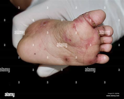 Scabies Lesions Hi Res Stock Photography And Images Alamy