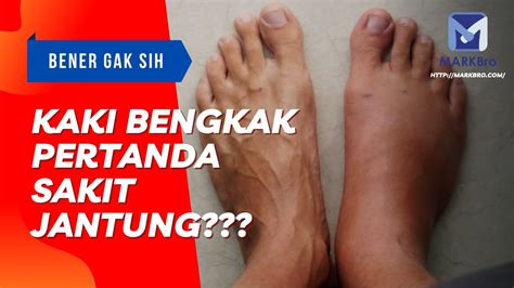 Markbro Kaki Bengkak Tanda Penyakit Jantung Youtube