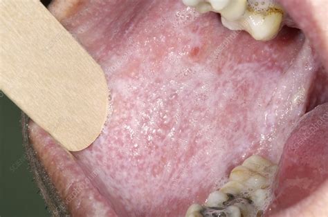 Oral Lichen Planus Disease Stock Image M2000269 Science Photo