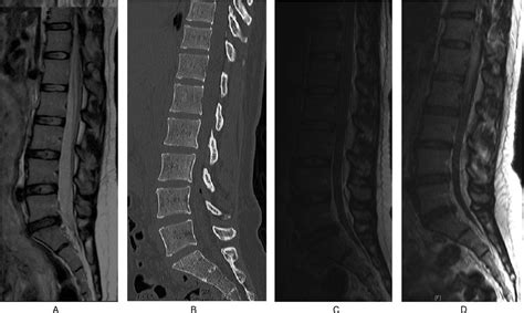 Adhesive Arachnoiditis With Extensive Syringomyelia And Gian Spine