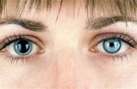 What Is Anisocoria Causes And Treatments Vision Center