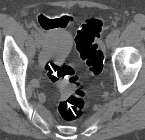 Evaluation Of Benign And Malignant Rectal Lesions With Ct Colonography