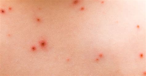 Terry King Berita Red Bumps On Skin After Beach