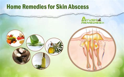 7 Best Home Remedies For Skin Abscess All Natural Treatments