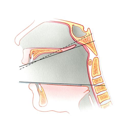Anterior Approaches To Clivus Skull Base Surgery Atlas