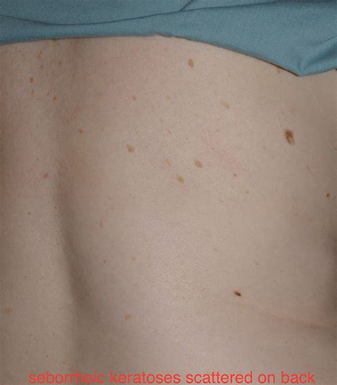 The Skin Spots We All Get Dermatology Consultants