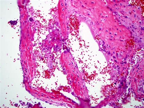 Aneurysmal Bone Cyst Pathology Orthobullets