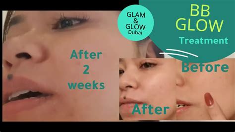 Bb Glow Treatment Weeks After Effect Review Glam And Glow Dubai Youtube