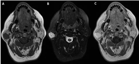 A Mri T1 Reveals In The Right Superficial Lobe Of The Parotid Gland A