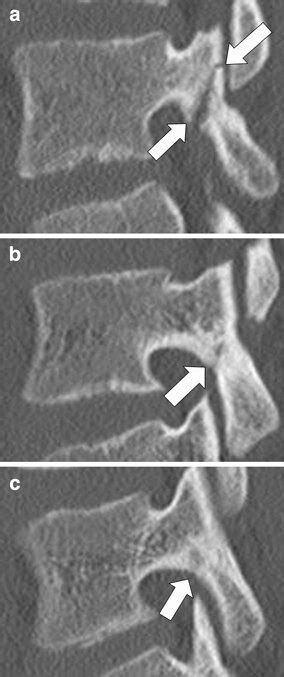 Ct Images Of Lumbar Stress Injuries Affecting The Pars Download