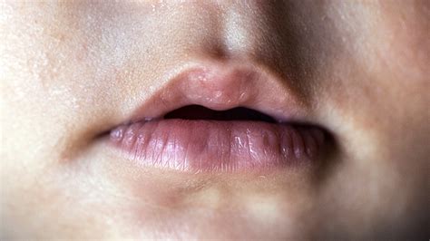 Lip Tie In Babies And Toddlers Symptoms And Treatment