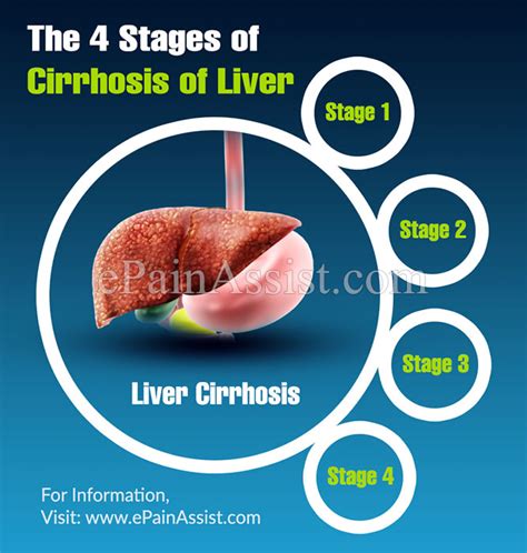 The 4 Stages Of Cirrhosis Of Liver