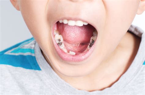 Start brushing your child's teeth as soon as first teeth appear in their mouth, brush the teeth and tongue and gums. The fluoridation debate continues at London City Hall ...