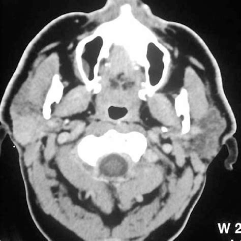 Ct Shows Enhanced Signal Of Right Parotid Gland With Homogeneous