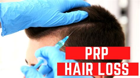 prp hair restoration in chicago for hair loss youtube