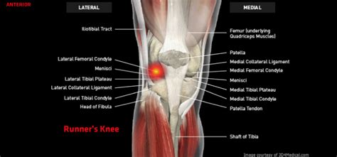Here are the simple ways you can avoid running injuries that could keep you sidelined. Runner's Knee (Iliotibial Band Friction Syndrome ...