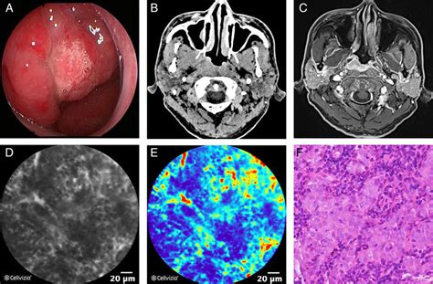 Nasopharyngeal Cancer