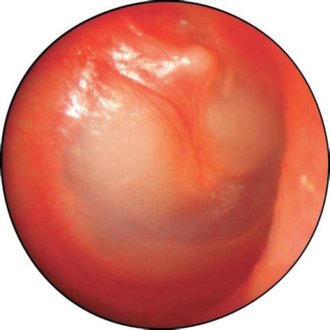 Tympanic Membrane Abnormalities Visual Diagnosis And Treatment In