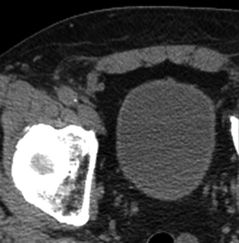 Amyand Hernia Ct Image Shows The Appendix Within An Amyands Hernia