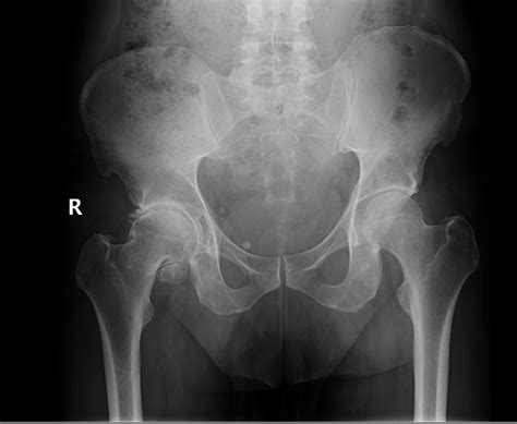 Total Hip Replacement Dr Mohamed Attia M D Phd