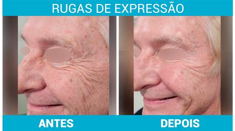 rugas de expressão o que são como prevenir e tratar os 3 tipos clínica de pele