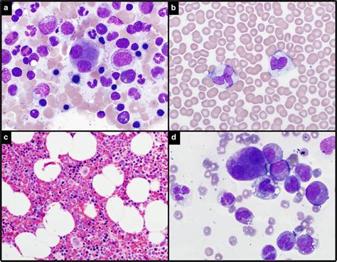 Peripheral Blood And Bone Marrow Aspirate And Biopsy A And D Bone