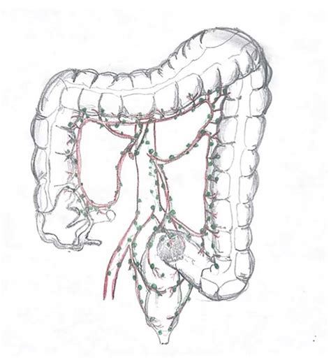Drawing Representation Of The Lymphatic System In Large Colon