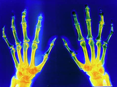 Bone damage in rheumatoid arthritis (ra) has three distinct phenotypes: X-ray Of Hand Showing Rheumatoid Arthritis Photograph by ...