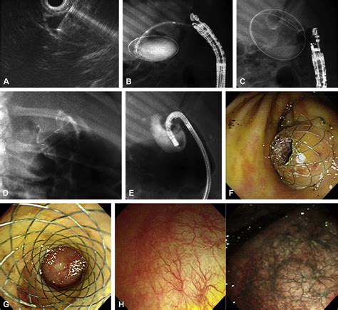 Figure 2 From A Newly Designed Fully Covered Metal Stent For Lumen