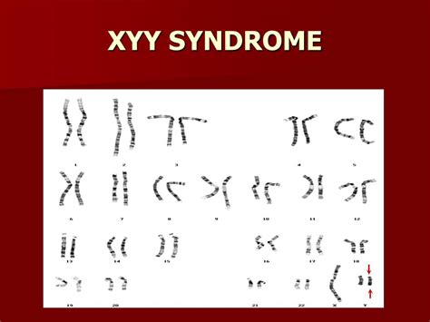 Xyy Syndrome Diagram