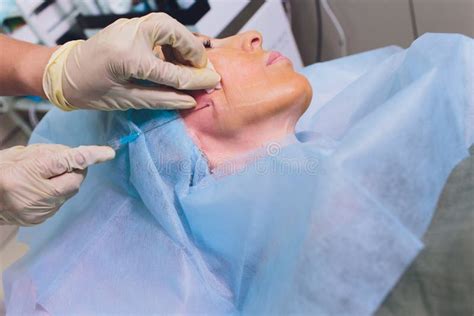 Aged Woman Doing Mesothreads And Thread Lifting Cosmetology Cosmetic Procedure To Eliminate