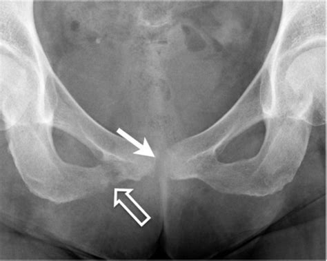 Anteroposterior Radiograph Of The Pelvis Shows A Fractu Open I