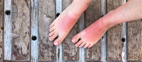 Sunburned Feet 5 Tips For Soothing Redness Burning And Swelling