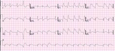 Dr Smiths Ecg Blog Subacute Anteroseptal Stemi With Persistent St