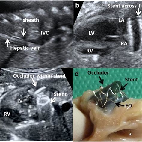 Ultrasound Images Of The Fetal Procedure To Occlude The Foramen Ovale