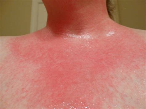 Allergic Reaction Skin Rash Pictures Pictures Photos