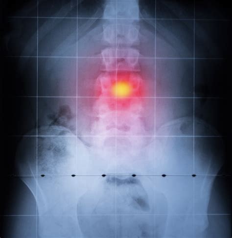 인체의 X 선 척추 및 골반 허리 통증이 빨간색으로 강조 표시됨 프리미엄 사진