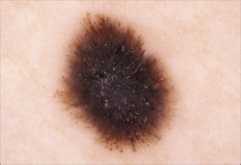 Dermoscopy Of Pigmented Spitz And Reed Nevi The Starburst Pattern