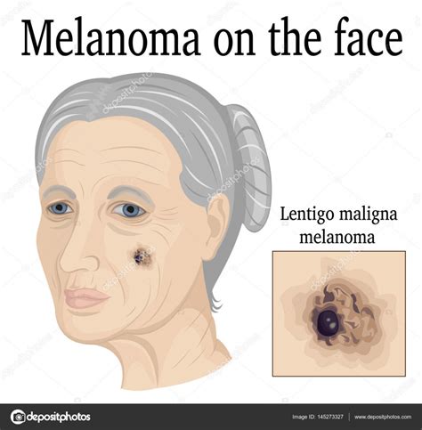 Melanoma On The Face — Stock Vector © 145273327