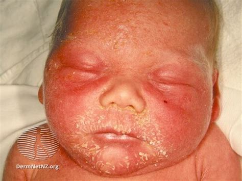 Staphylococcal Scalded Skin Syndrome Wikiprojectmed